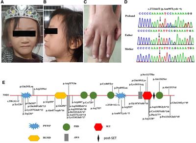 Case report: A de novo NSD2 truncating variant in a child with Rauch-Steindl syndrome